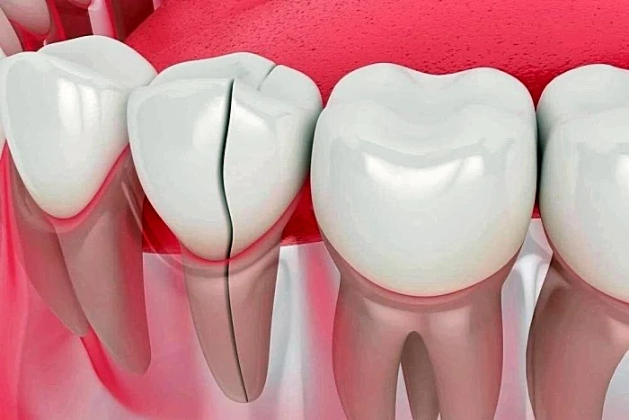 How to Fix a Cracked Tooth Naturally